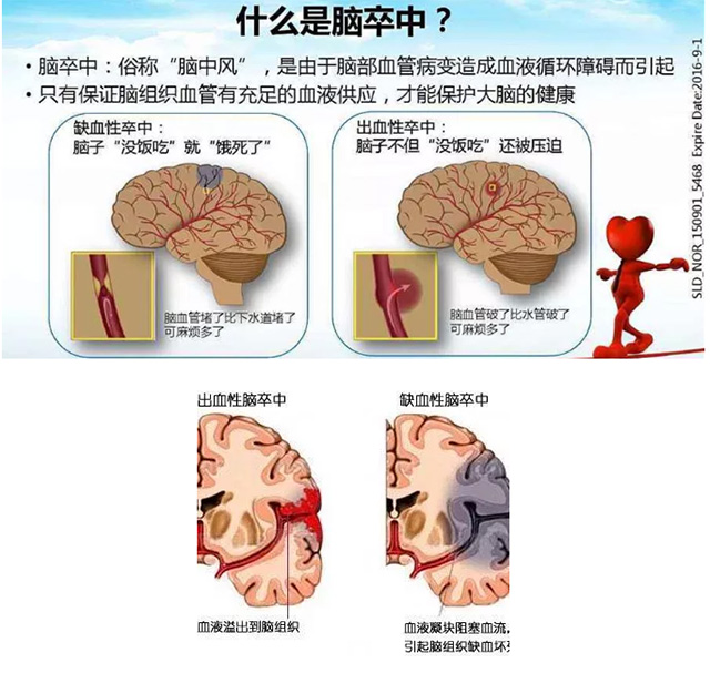 ​卒中 的常见后遗症有哪些 中风